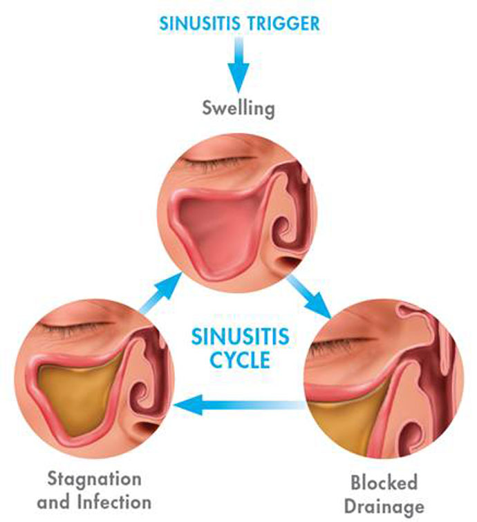 blocked sinus