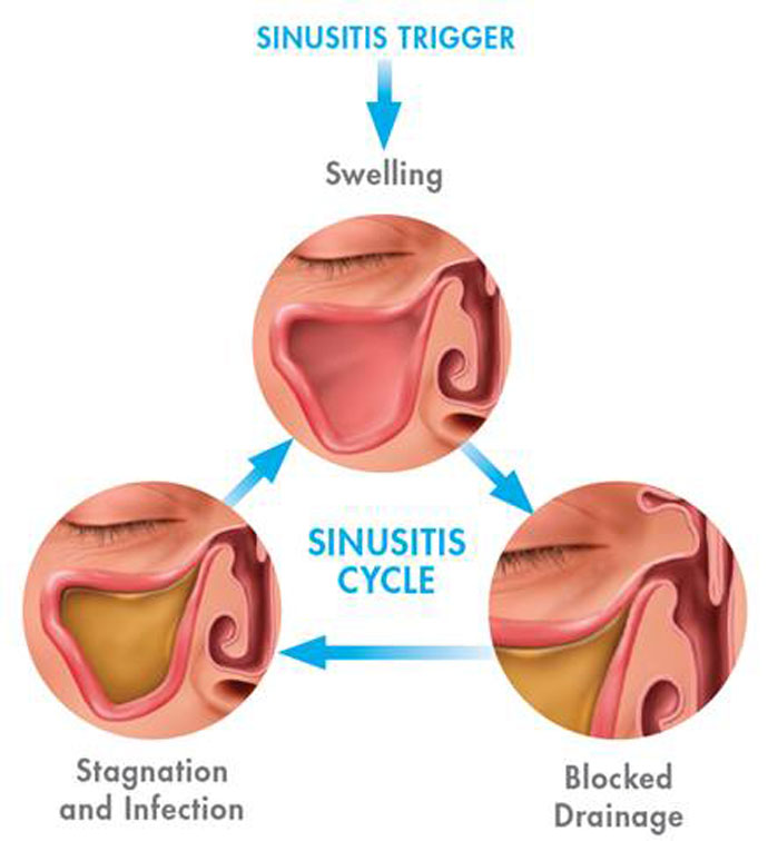 What Causes My Sinus Issues? Sahasra ENT Clinic