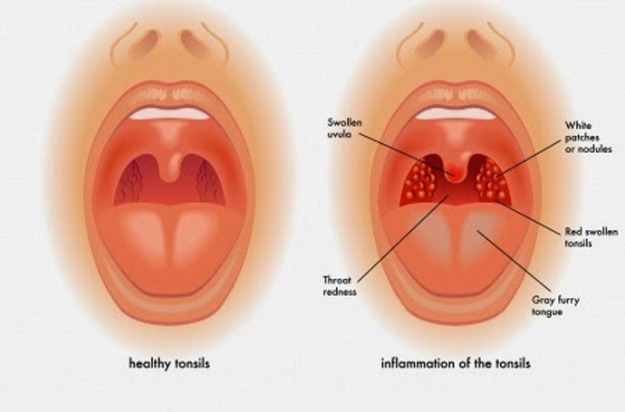 Tonsillitis-Sinha-copy